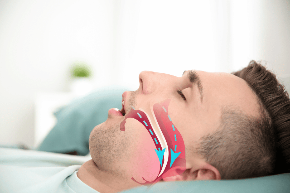 Understanding Sleep Apnea: How It Contributes to Loud Snoring